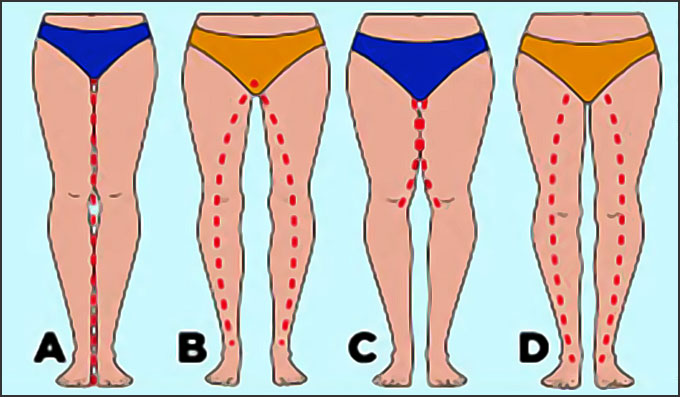 les differentes formes de hanches de cuisses et dentrecuisses