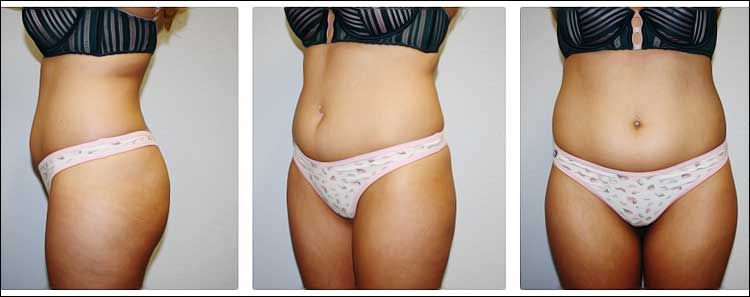 lifting bresilien des fesses