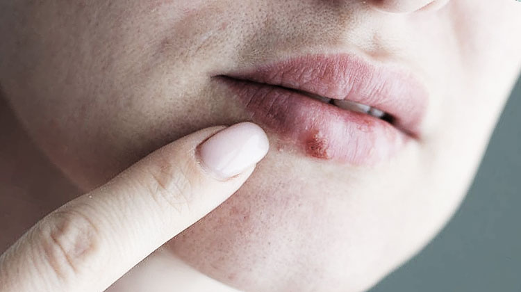 ma femme a de l herpes