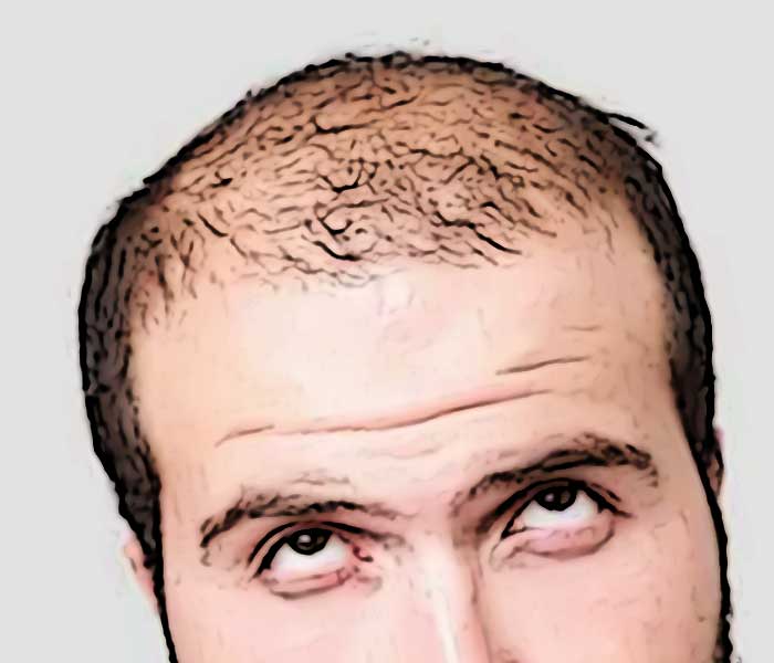 homme devient chauve